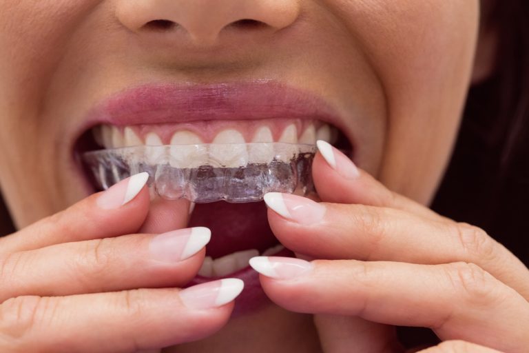 A person inserting a clear dental aligner as one method to reduce teeth grinding and protect teeth.