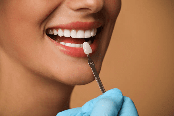 composite veneers