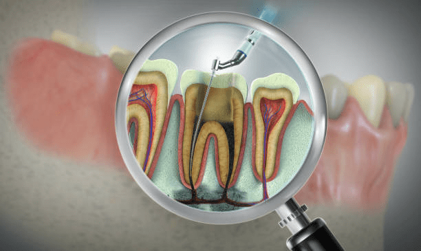 Tooth cross-section showing root canal treatment.